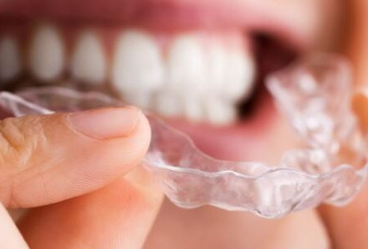 Allineatori Ortodontici Trasparenti: Comfort integrato all'Estetica Dentale